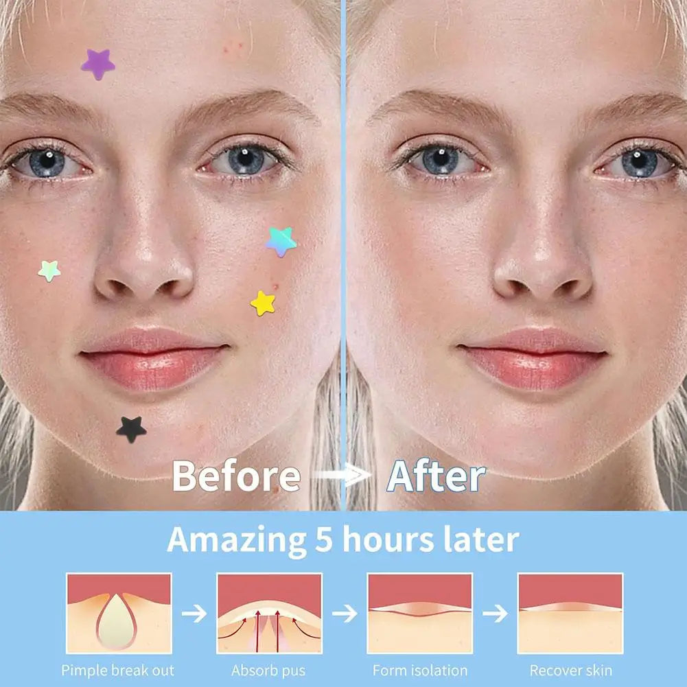Colorful Star Acne Pimple Patch