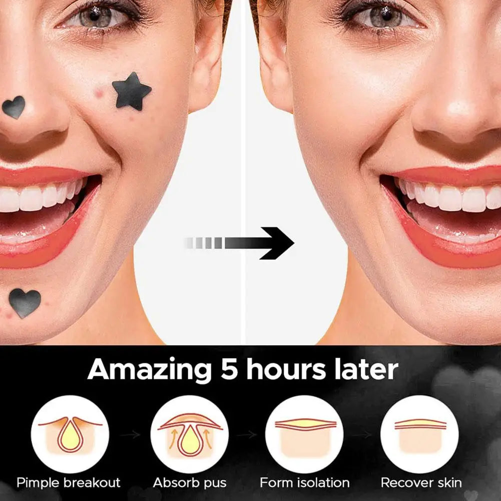 Colorful Star Acne Pimple Patch