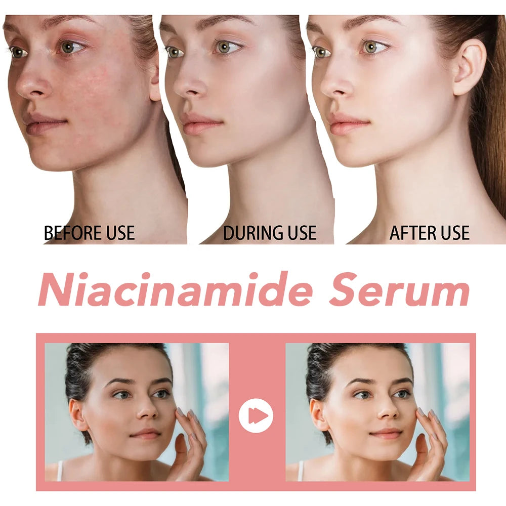 30ml Niacinamide Serum – Melanin Removal & Pore Shrinking