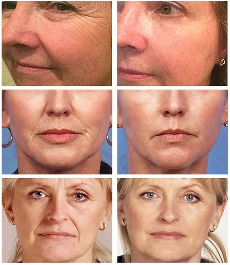 Retinol Wrinkle Removing Cream – Anti-Aging & Brightening